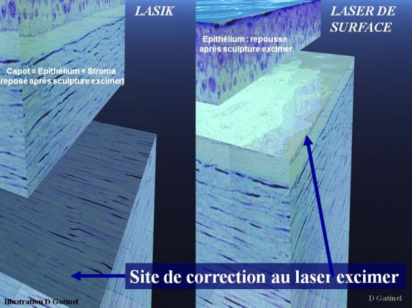 Laser ou lasik site