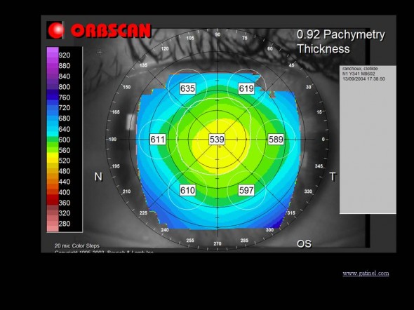 carte tomographique topographie cornéenne pachymétrie Orbscan