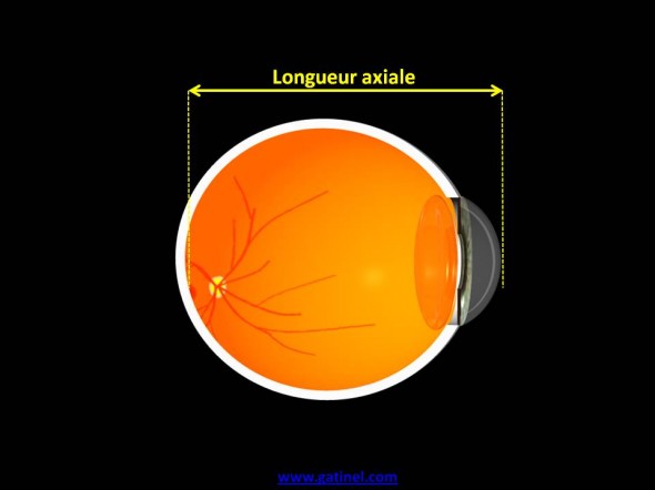 longueur axiale oeil