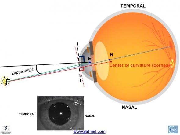 pupillary axis angle kappa