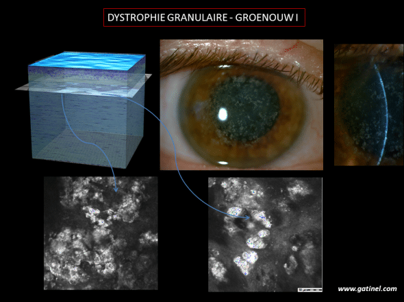 Aspect  biomicroscopique et en microscopie confocale de la dystrophie granulaire (Groenouw I). Les dépôts hyperréflexifs sont bien visibles. En microscopie optique, ces dépôts hyalins adopteraient une coloration rouge vif en utlisant un colorant dit « trichrome de Masson ». 