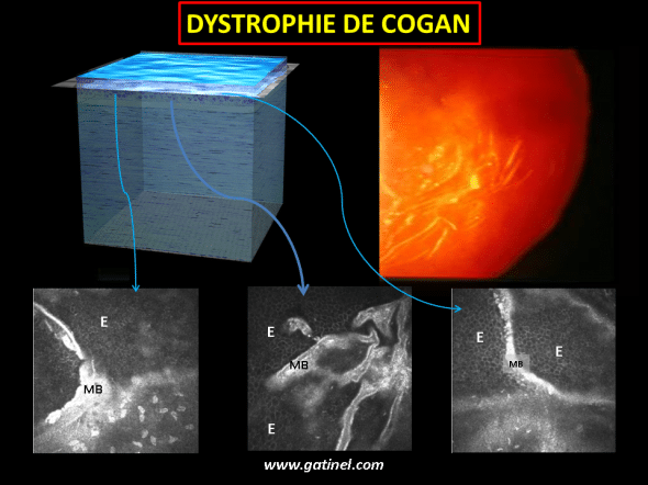  microscopie confocale dystrophie basale Cogan (HRT)