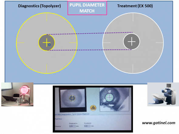 The comparison between the pupil diameter at the Topolyzer and under the EX 500 excimer laser is performed during registration. It is important to obtain comparable values. This ensure adequate pupil center location with regards to the limbus, in case of large pupil center shift when mydriasis  or myosis occurs.