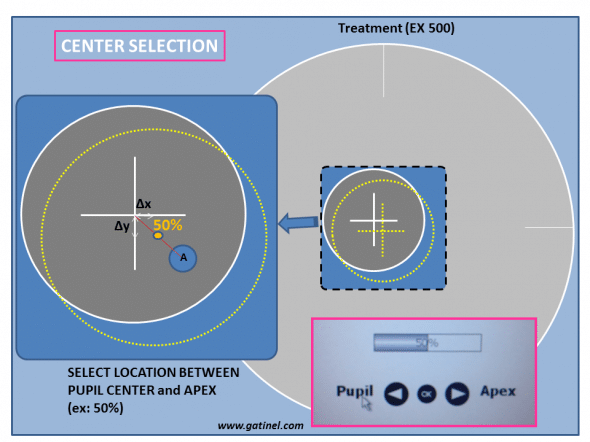 As the location of the corneal Apex relative to the pupil center is known, any point in between these two landmarks can be used to center the laser ablation.