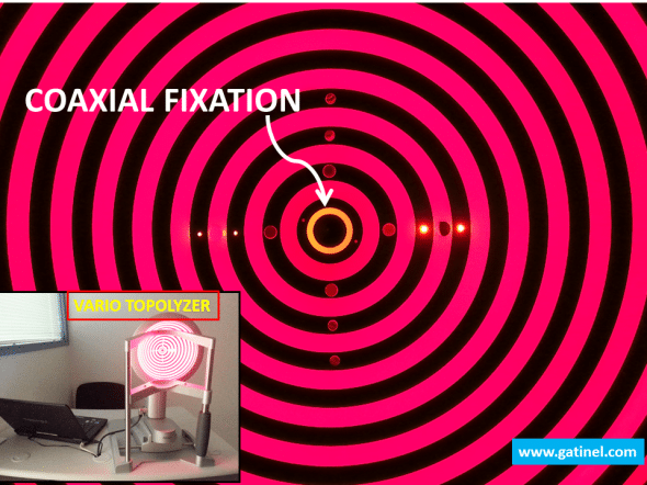 The eye fixates the center of the Placido rings, and is coaxial with the Topolyzer camera which stands along the same axis.