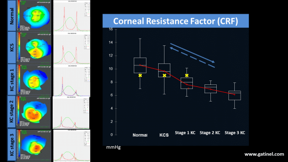 Quand on étudie la résistance cornéenne en fonction du stade du kératocône, on observe que l'instrument ORA met en évidence une tendance significative à la réduction de la valeur du CRF avec la progression du kératocône. Si le CXL était efficace, il n'y a aucune raison logique pour que l'instrument ne mette pas en évidence une augmentation de la résistance cornéenne (flèche pointillée).