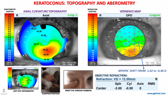 corneal topography and vergence map